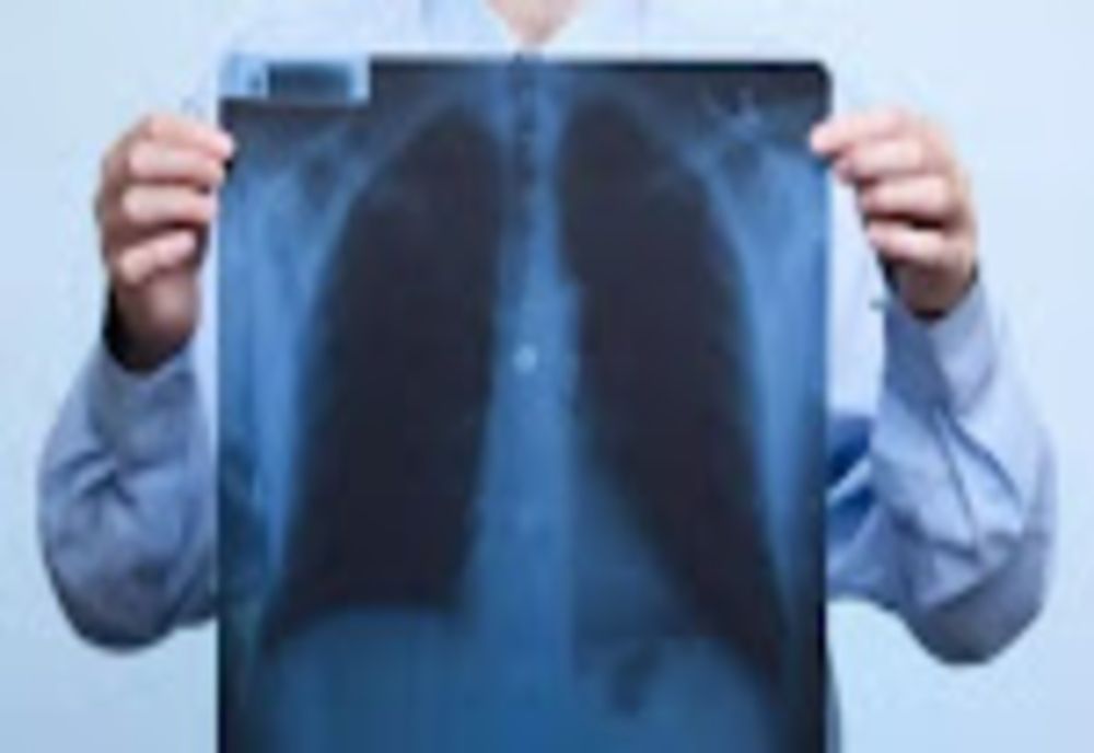 Cum arată plămânii unui pacient nevaccinat, bolnav de COVID - Medicii, îngroziți de imagini! - FOTO șocant în articol